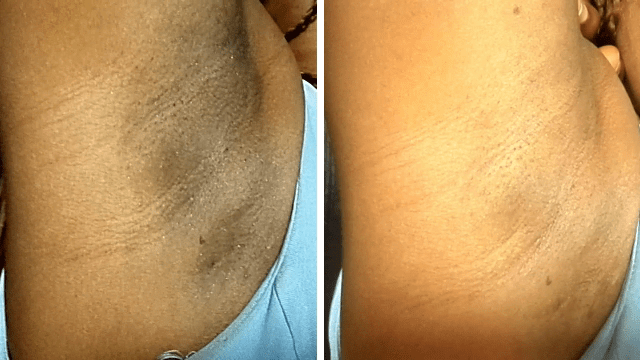 Antes e Depois - Testa